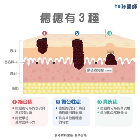 為什麼會長毛|痣形成的原因？痣長毛、痣變多變大是痣病變？5招判別